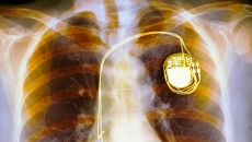 Pacemaker X-ray.