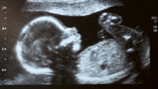 fetal ultrasound